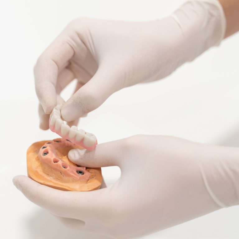 dental implant idim